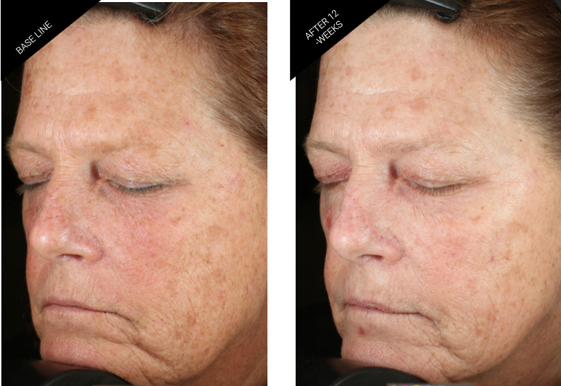 アルティメイト　エッセンスR Retinol Renewal Serum — Isabelle McLeod Aesthetics